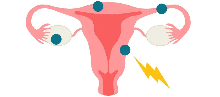 Infographic of uterus with shock pain