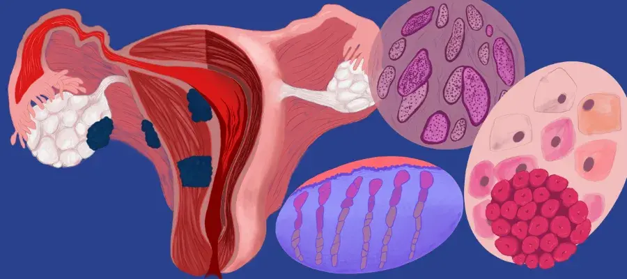 artistic representation of womb, fibroids, cancer tissue, HPV and cysts