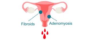 infographic of bleeding uterus labelled with 'fibroids' and 'adenomyosis'
