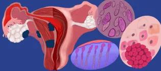 artistic representation of womb, fibroids, cancer tissue, HPV and cysts