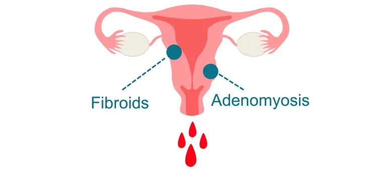 infographic of bleeding uterus labelled with 'fibroids' and 'adenomyosis'