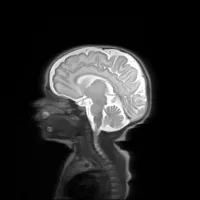 Baby brain MRI scan