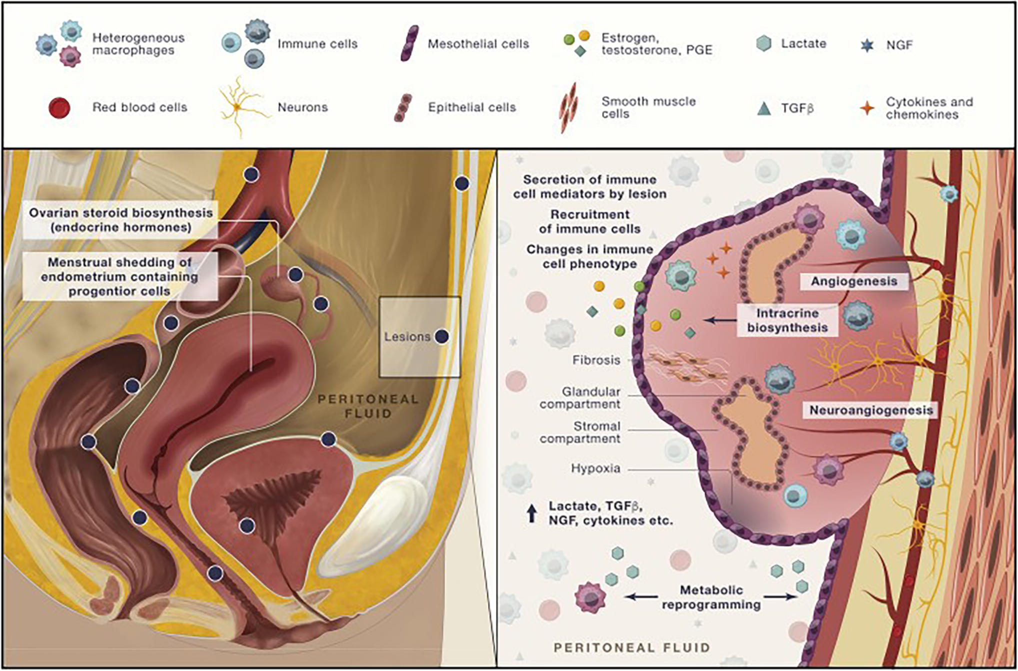 Infographic of Endometriosis Lesions