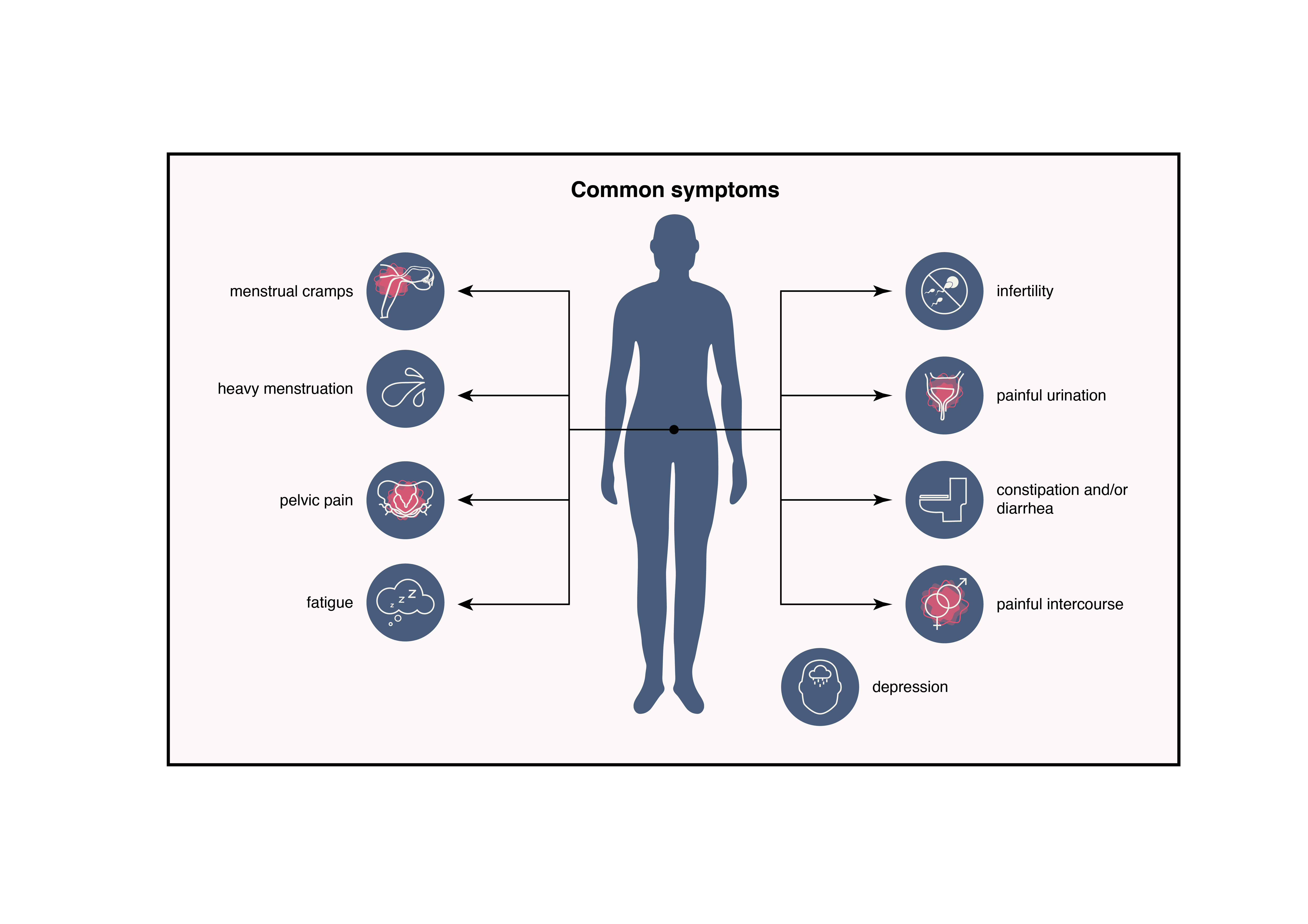 Endo symptoms graphic