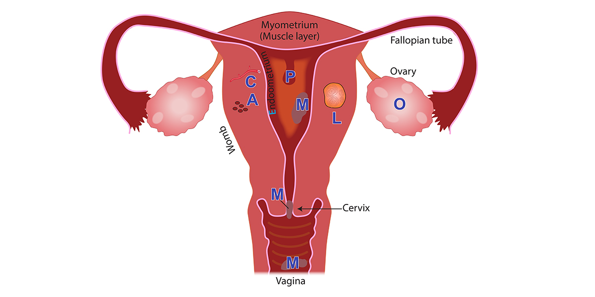 Menstrual-Disorders-Image-11-Mar-2020