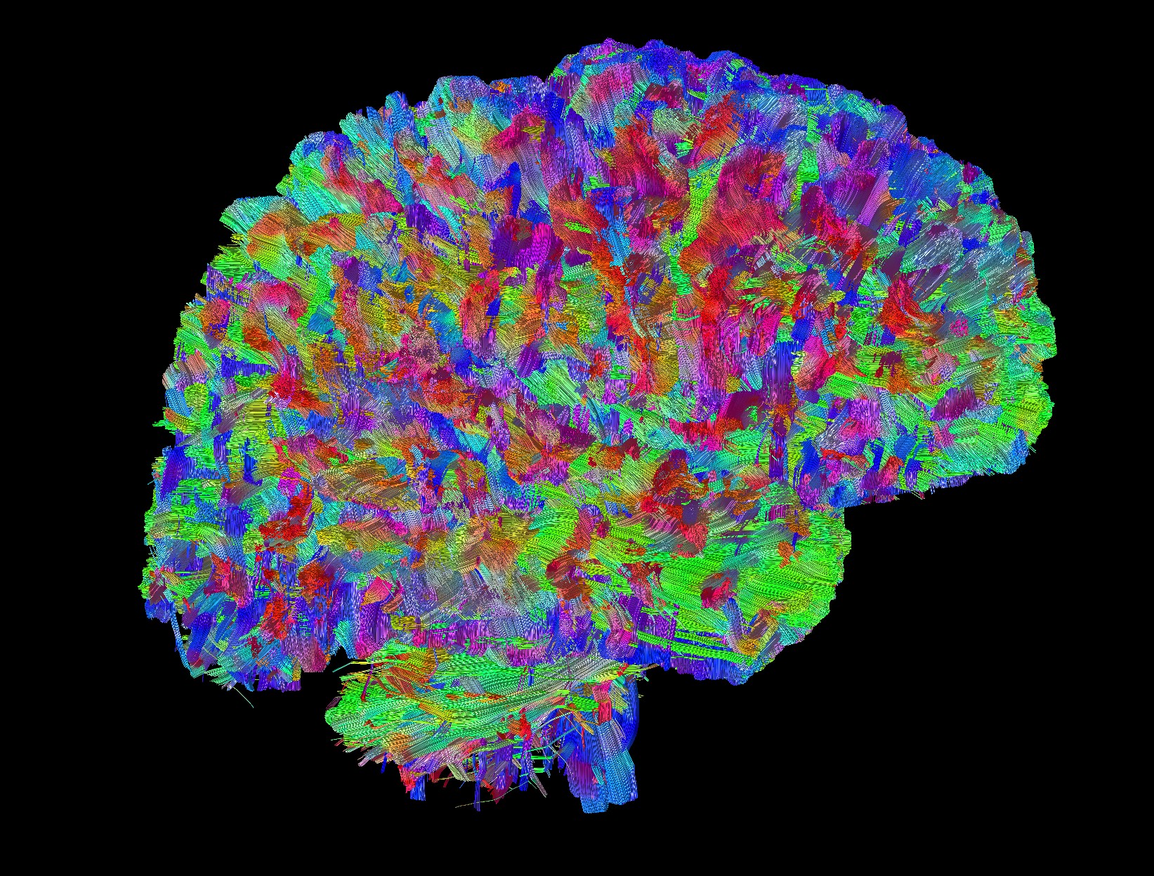 Newborn brain MRI scan